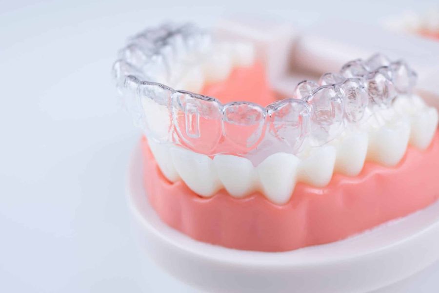 Aligner-Zahnschiene auf einem Zahnmodell