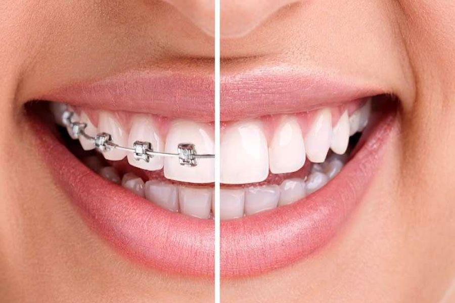 Wie man zwischen den verschiedenen Arten von Zahnspangen wählt: Der vollständige Leitfaden